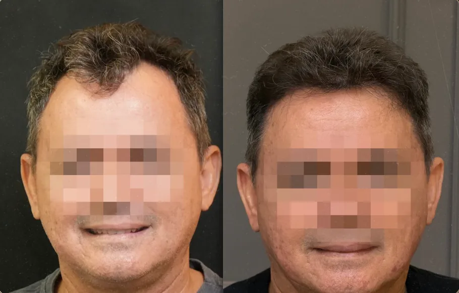 Caso 3 de transplante capilar, comparação antes e depois