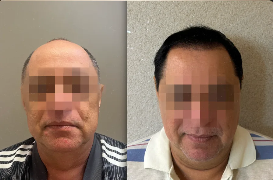 Caso 6 de transplante capilar, comparação antes e depois