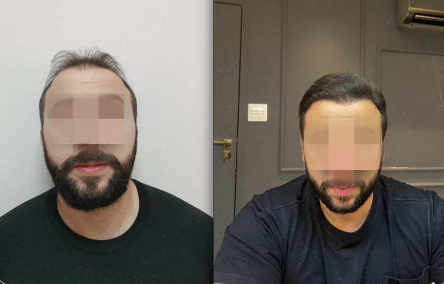 Caso 4 de transplante capilar, comparação antes e depois