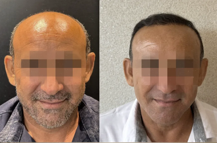 Caso 7 de transplante capilar, comparação antes e depois
