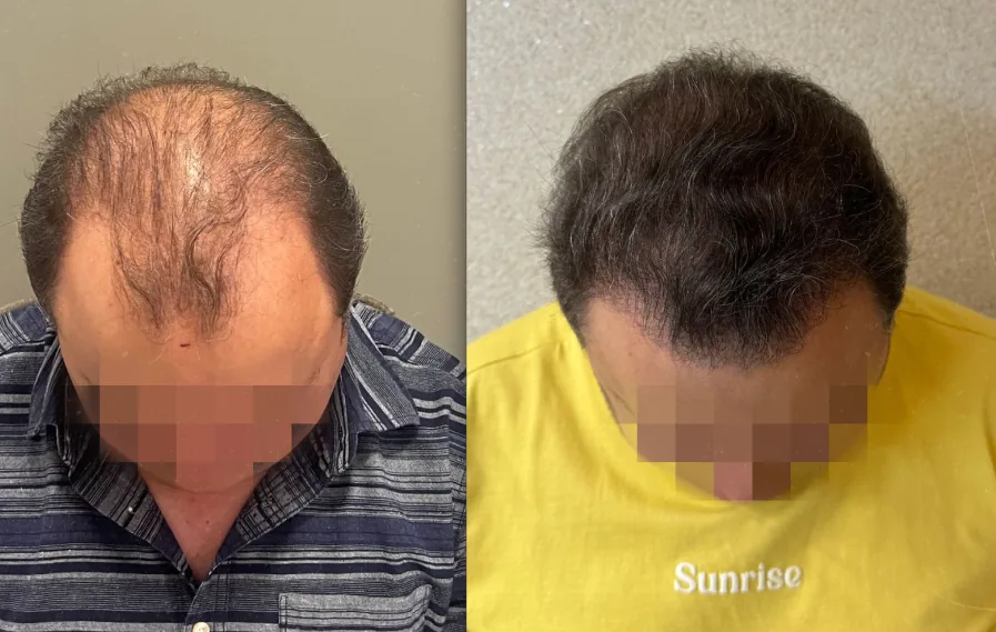 Caso 2 de transplante capilar, comparação antes e depois