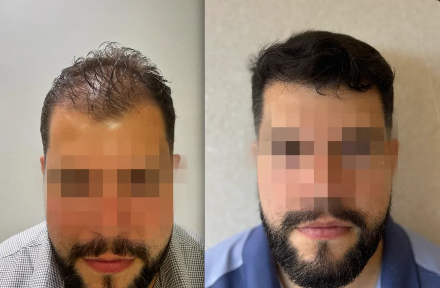 Caso 1 de transplante capilar, comparação antes e depois