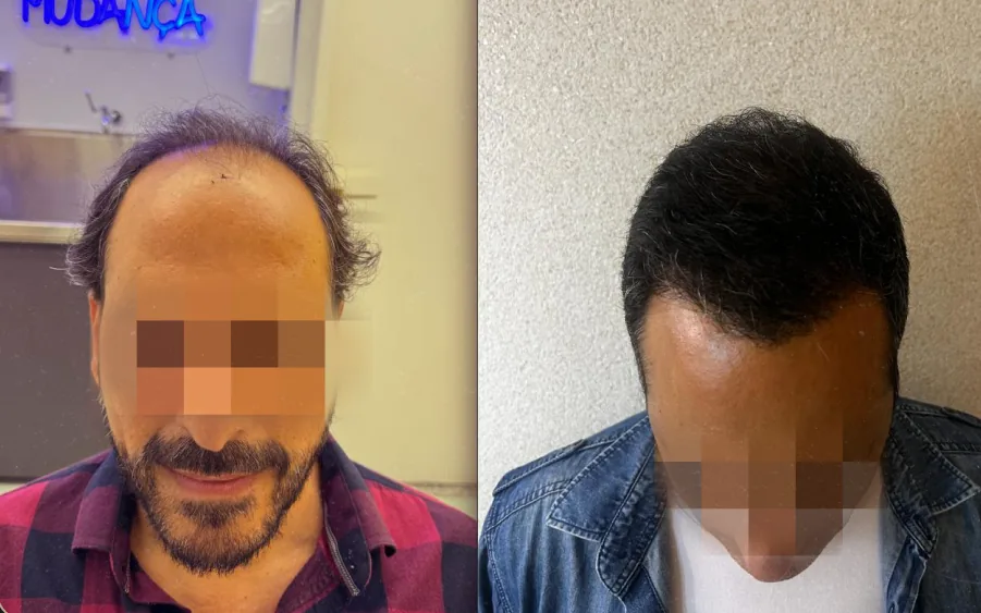 Caso 5 de transplante capilar, comparação antes e depois